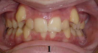 TipEdge Braces - Step 1