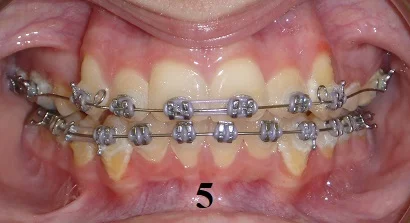 TipEdge Braces - Step 5