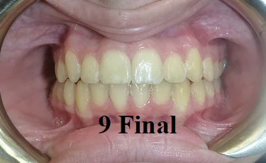 TipEdge Braces - Step 9