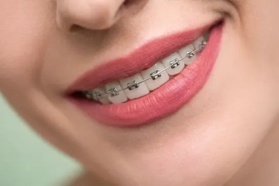 Smile during orthodontic treatment with braces