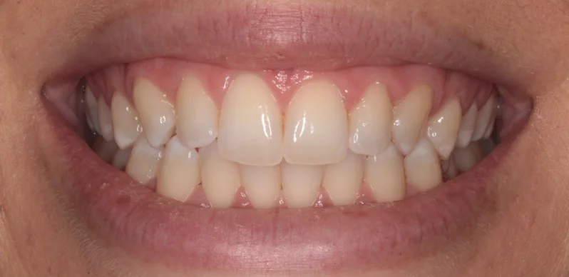 Before whitening